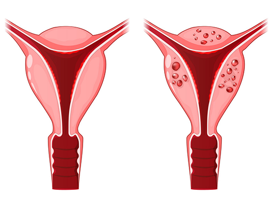 sintomas e tratamentos da adenomiose