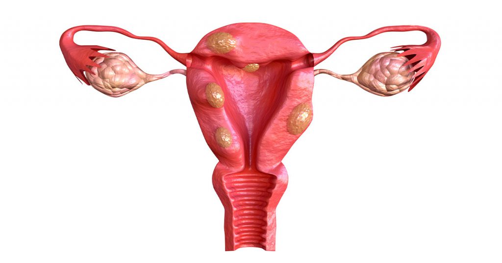 Miomas Uterinos