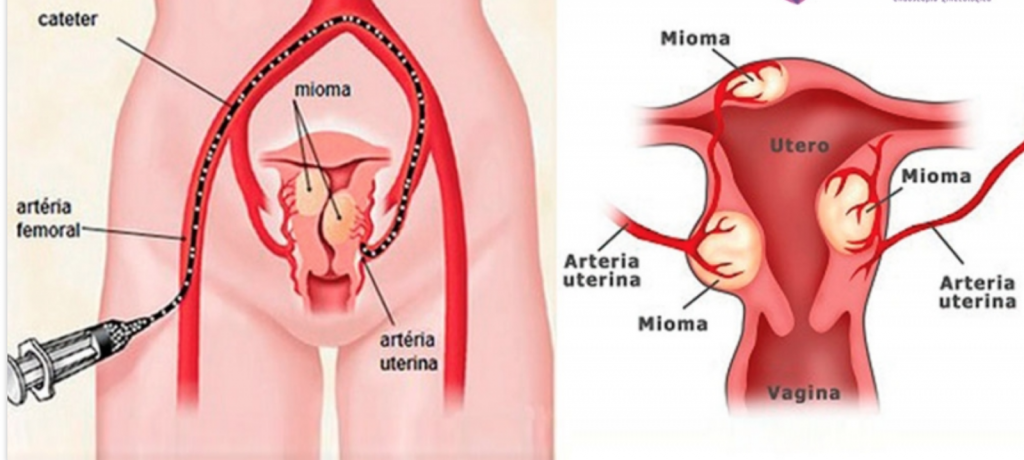 Miomas Uterinos
