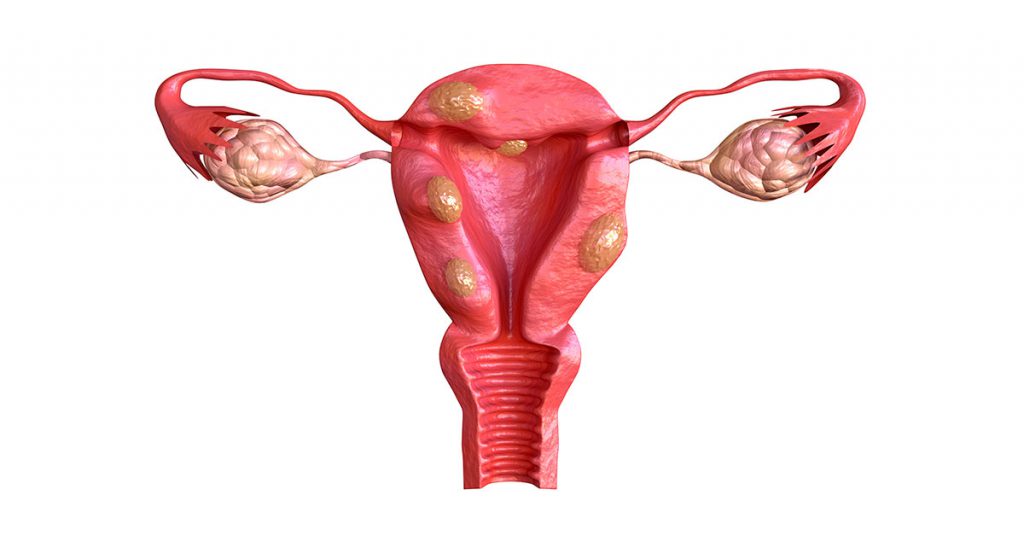 Prolapso Uterino