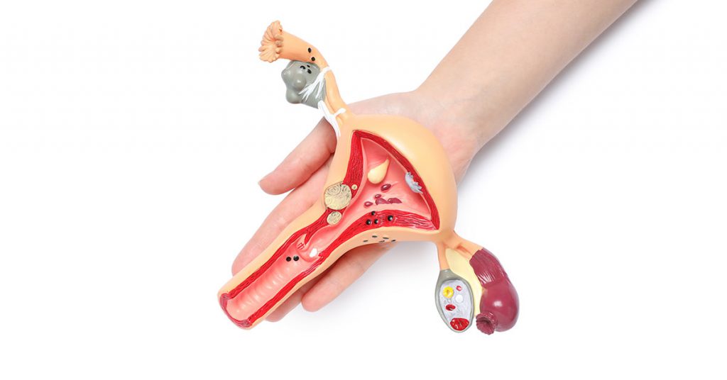 Pólipos Endometriais
