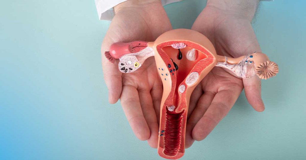 Endometriose e Ovário Policístico: Saiba mais sobre essas duas doenças ginecológicas