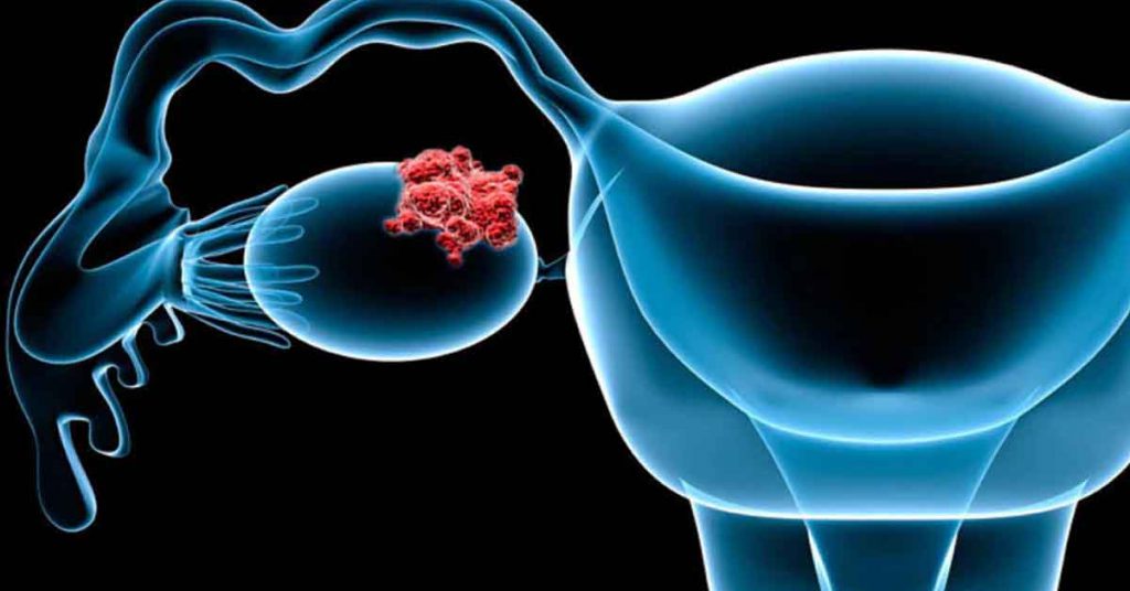 Sintomas de Tumor de Ovário: Como Identificar os Sinais
